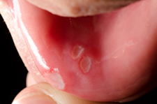 Teeth Trauma: It's a Sensitive Issue