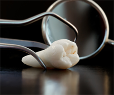 Teeth Trauma: It's a Sensitive Issue