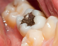 Ditch Discolored Fillings for These Newer, Lighter Options