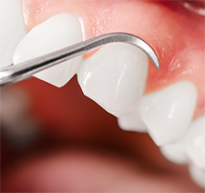 Teeth Trauma: It's a Sensitive Issue