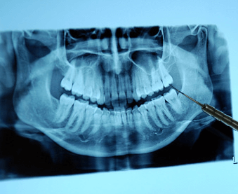 Teeth Trauma: It's a Sensitive Issue