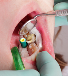 Teeth Trauma: It's a Sensitive Issue