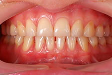 Teeth Trauma: It's a Sensitive Issue