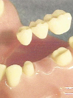Teeth Trauma: It's a Sensitive Issue