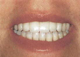 Teeth Trauma: It's a Sensitive Issue