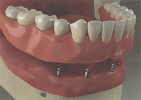 Teeth Trauma: It's a Sensitive Issue