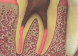 Teeth Trauma: It's a Sensitive Issue