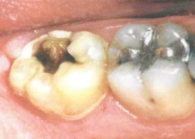 Alternatives to Single Tooth Extraction