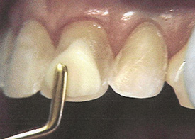 Teeth Trauma: It's a Sensitive Issue