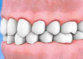 Teeth Trauma: It's a Sensitive Issue