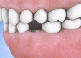 Teeth Trauma: It's a Sensitive Issue