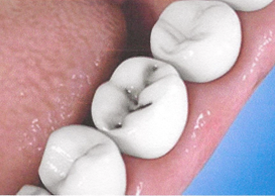 Teeth Trauma: It's a Sensitive Issue