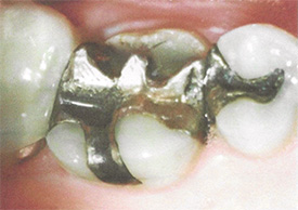 Failing Amalgam Fillings