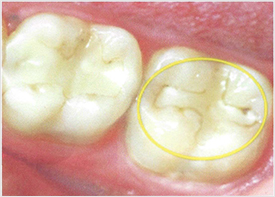 Teeth Trauma: It's a Sensitive Issue