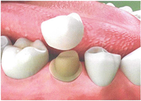 Teeth Trauma: It's a Sensitive Issue