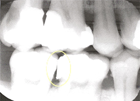 Teeth Trauma: It's a Sensitive Issue