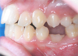 Teeth Trauma: It's a Sensitive Issue