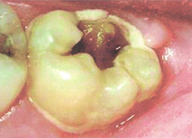 Teeth Trauma: It's a Sensitive Issue