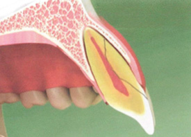 Considering Extraction for a Fractured Tooth