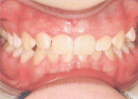 Teeth Trauma: It's a Sensitive Issue