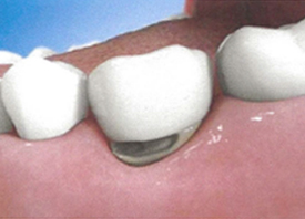 Teeth Trauma: It's a Sensitive Issue