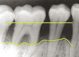 Teeth Trauma: It's a Sensitive Issue