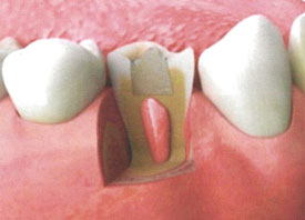 Teeth Trauma: It's a Sensitive Issue