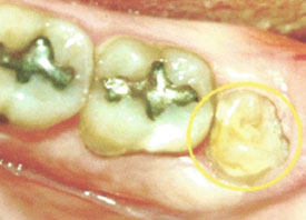 Teeth Trauma: It's a Sensitive Issue