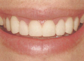 Teeth Trauma: It's a Sensitive Issue