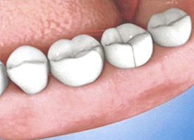 Teeth Trauma: It's a Sensitive Issue