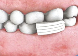 Teeth Trauma: It's a Sensitive Issue