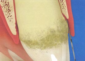 Teeth Trauma: It's a Sensitive Issue