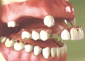 Flexible Partial Dentures
