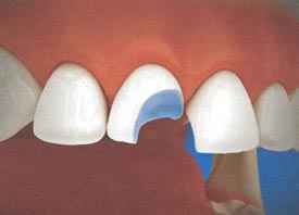 Teeth Trauma: It's a Sensitive Issue