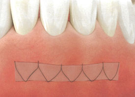 Teeth Trauma: It's a Sensitive Issue