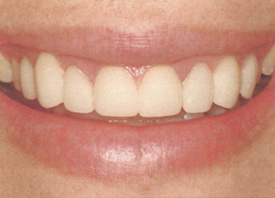 Teeth Trauma: It's a Sensitive Issue