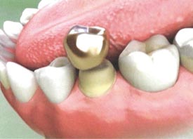Teeth Trauma: It's a Sensitive Issue