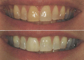 Teeth Trauma: It's a Sensitive Issue