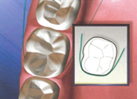 Teeth Trauma: It's a Sensitive Issue