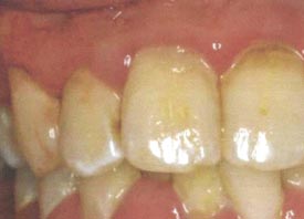 Full Mouth Debridement