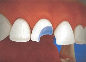 Teeth Trauma: It's a Sensitive Issue