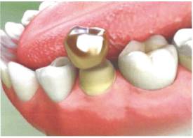 Teeth Trauma: It's a Sensitive Issue