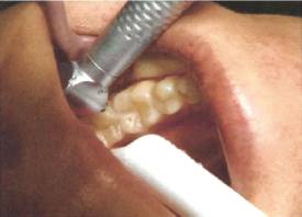 Teeth Trauma: It's a Sensitive Issue