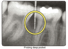 Teeth Trauma: It's a Sensitive Issue